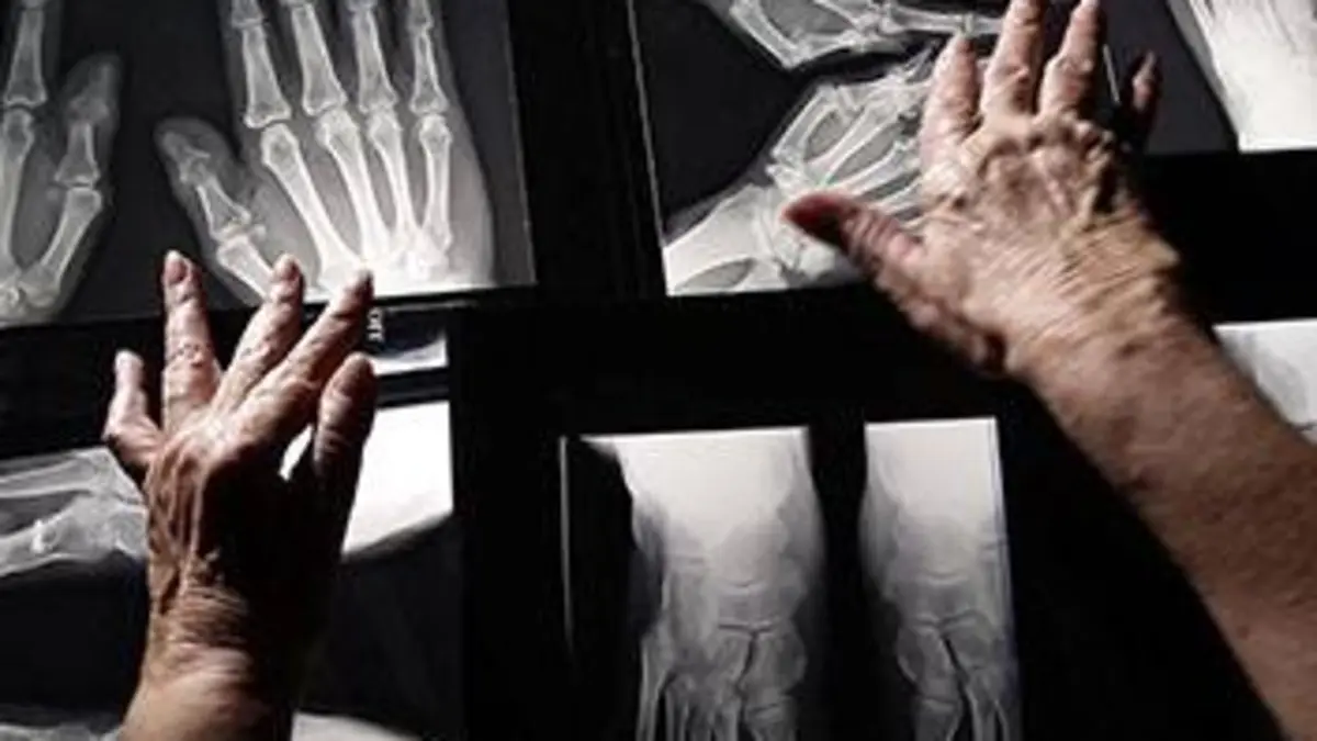 Rhumatismes, pourquoi ça coince ?